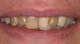 Multiple discolored and improperly positioned teeth