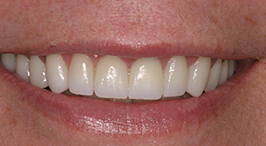 Whiter and better aligned teeth