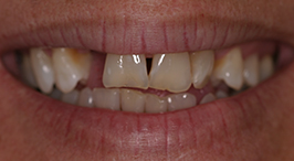 Smile with damaged and missing teeth