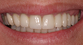 Smile with replaced and repaired teeth