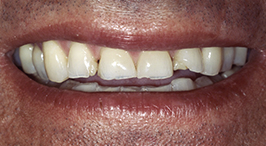 Multiple worn down teeth