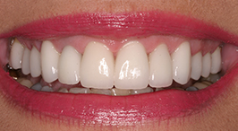 Close-up of more aesthetically pleasing teeth