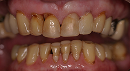 Multiple damaged and discolored teeth