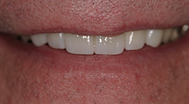 Close-up of repaired, whiter smile