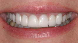 Smile with whiter teeth