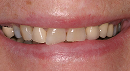 Smile with multiple discolored teeth