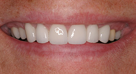 Smile after discoloration has been corrected