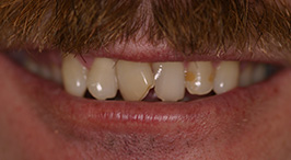 Close-up of smile with misshapen teeth