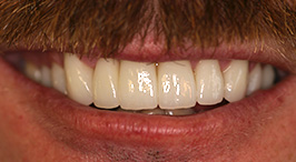 Close-up of smile with properly sized and shaped teeth