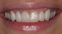 Smile with white properly aligned teeth