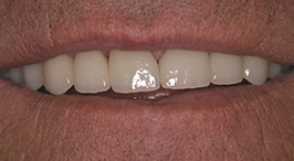 Smile with properly spaced front teeth