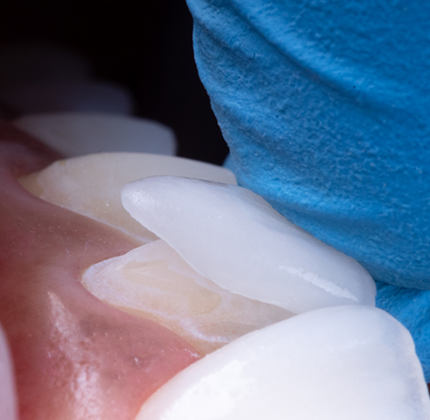 Close-up of veneers being placed on tooth