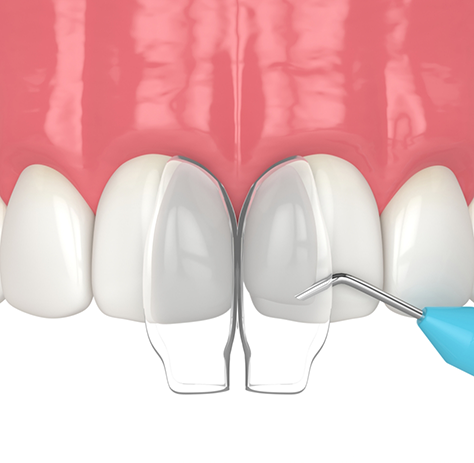 Illustration of cosmetic bonding performed on upper arch