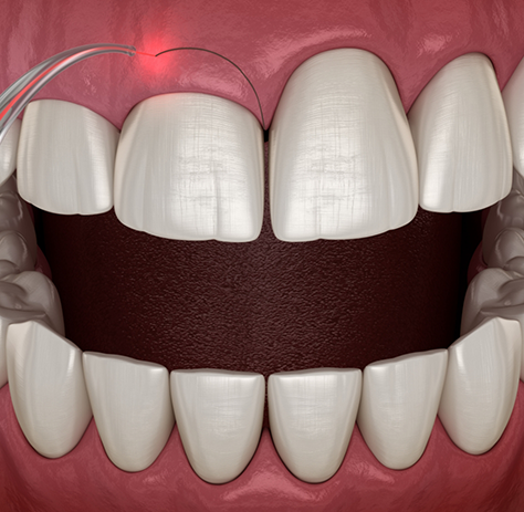 Illustration of gum recontouring being performed with laser