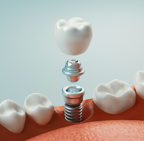 Illustration of abutment and crown being attached to dental implant