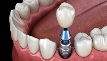 Illustration of crown being attached to dental implant in lower arch