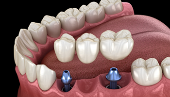 Illustration of dental bridge being attached to dental implants