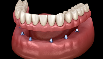 Illustration of denture being attached to dental implants