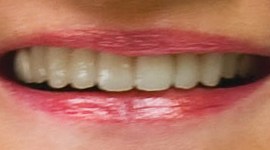 Smile with properly shaped and shaded teeth