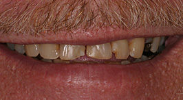 Close-up of worn down, yellowed teeth