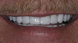 Whiter teeth in revitalized smile