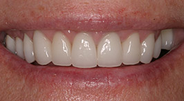 Smile after worn down teeth have been restored