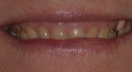 Severely worn down teeth in upper arch