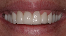 Smile with oral health restored