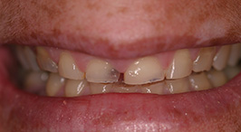 Severely worn down improperly spaced teeth