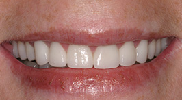 Restored and correctly aligned teeth