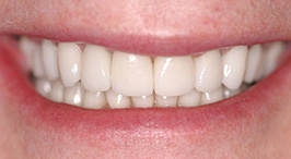 Smile with replaced and brighter teeth