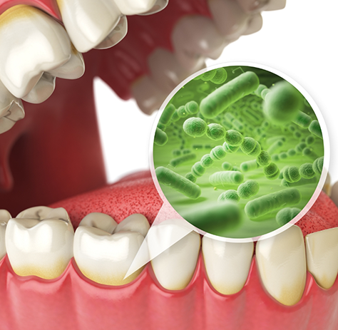 Illustration of gums with indicator showing bacteria