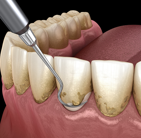 Illustration of scaling and root planing for lower arch