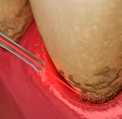 Close-up of dental laser treating gums