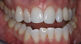 Close-up of smile with missing tooth replaced