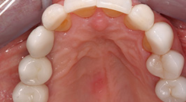 Overhead view of lower arch with teeth replaced with dental implants