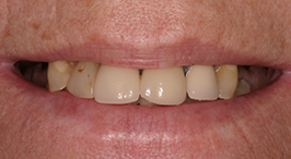 Close-up of dull, incomplete smile