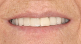 Close-up of brighter, complete smile