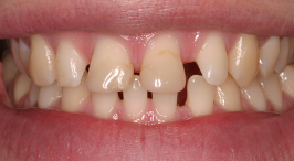 Smile with large gaps between teeth