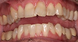 Improperly aligned teeth