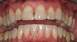 Teeth with alignment problems corrected