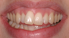 Protruding front tooth overlapping other teeth