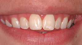 Dental patient with misaligned bite