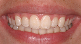 Dental patient with corrected bite