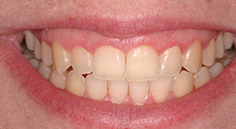 Smile with orthodontic issues corrected