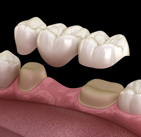 Illustration of dental bridge being attached to natural teeth