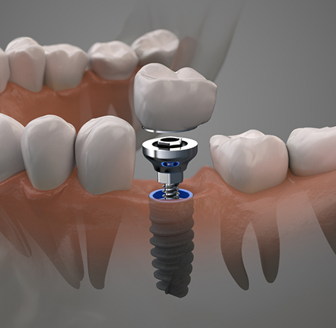 Illustration of abutment and crown being attached to dental implant