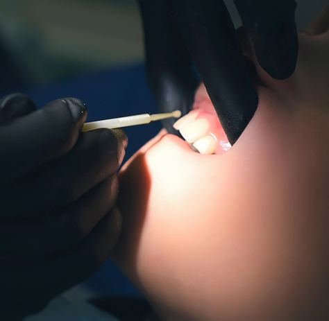 Close-up of teeth receiving fluoride treatment