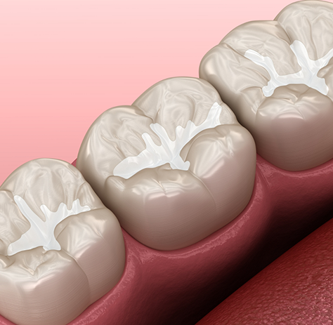 Illustration of teeth protected by dental sealants