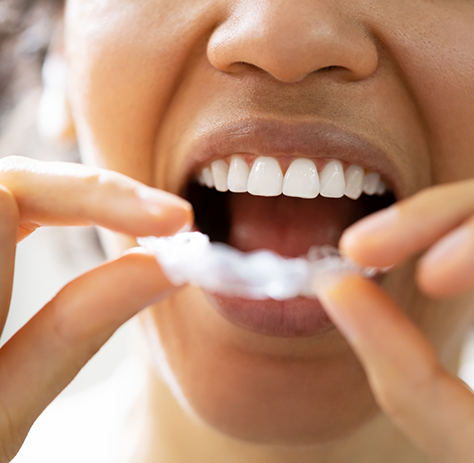 Man about to put nightguard on upper teeth